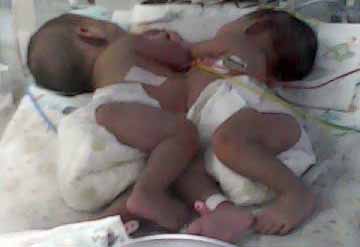 Bayi Kembar Siam Dempet Perut Lahir di Ciamis